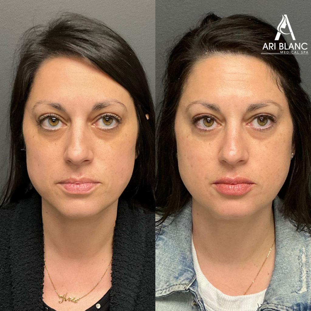Facial Balancing with Collagen Stimulating Sculptra Treatment Philadelphia | Ari Blanc Medical Spa Sculptra treatment in Philadelphia at Ari Blanc Medical Spa showing facial volume restoration and a refreshed, natural-looking appearance.