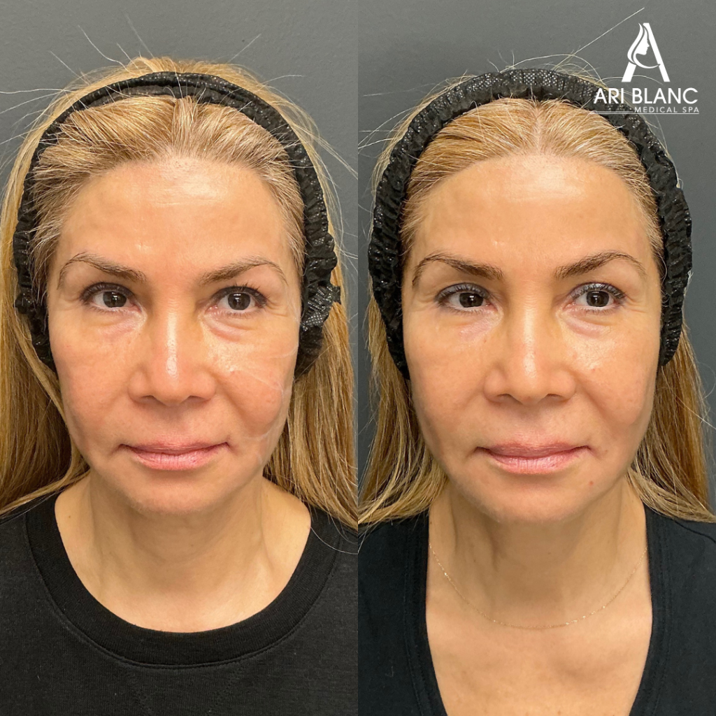 Sculptra Before and After - Sculptra Near Me in Old City, Fishtown, Queens Village Philly | Ari Blanc Medical Spa Sculptra before and after in Philadelphia showing restored facial volume, improved cheek fullness, and a more refreshed appearance.