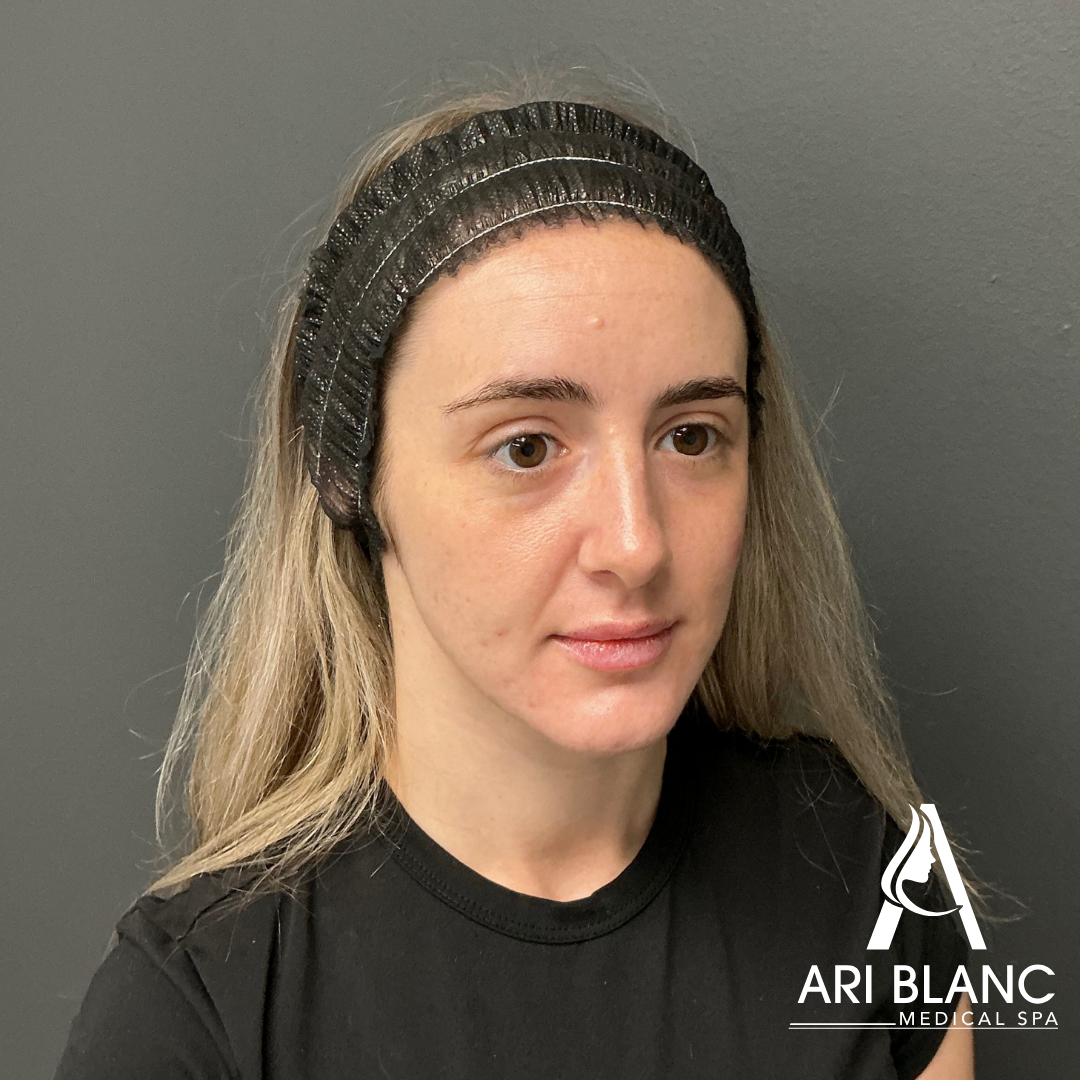 Ari Blanc Facial Balancing Before