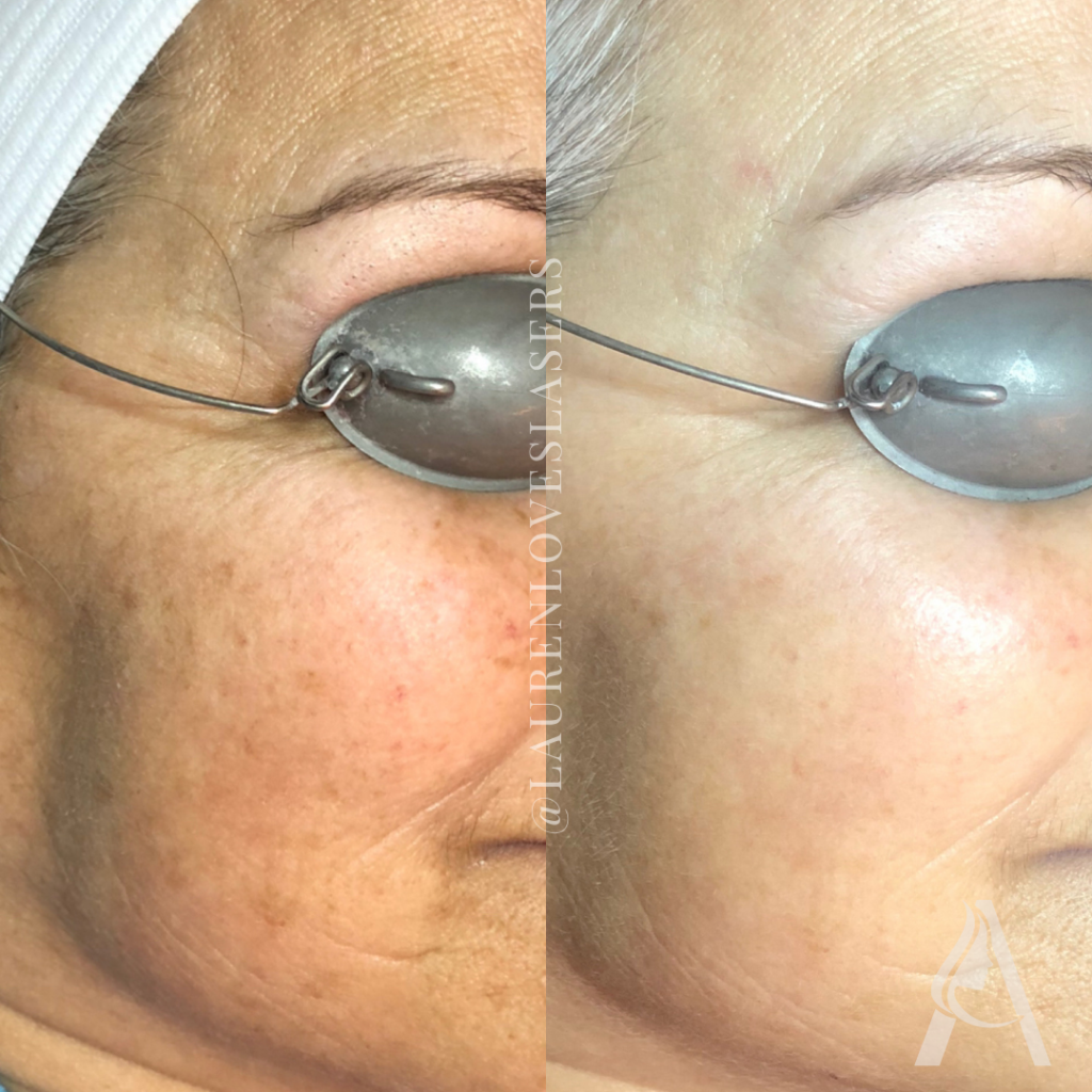 BBL HEROIC Before and After BroadBand Light Treatment Ari Blanc Philadelphia BBL HEROic facial before and after in Philadelphia showing improved tone, brighter skin, and reduced discoloration.