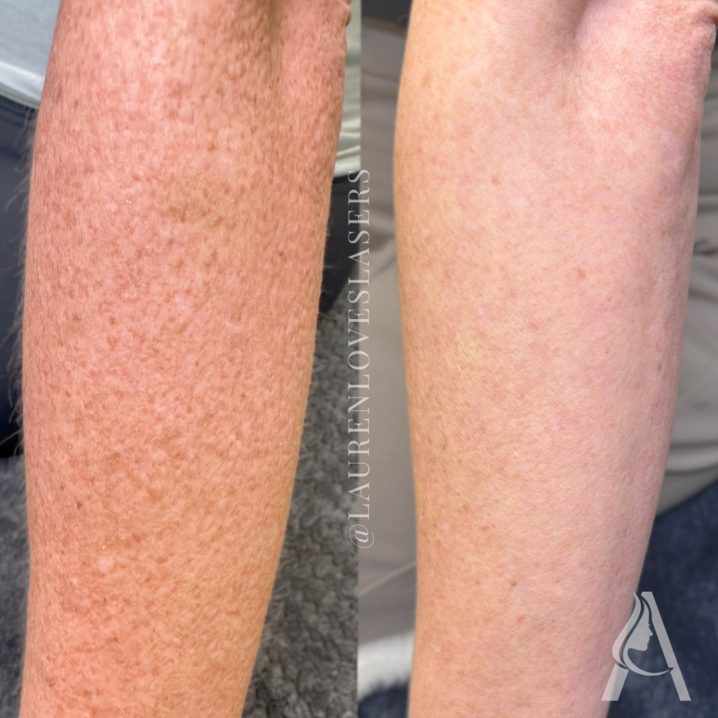 BBL Heroic BroadBand Light Treatment for Sun Damage Redness and Dark Spots at Ari Blanc Medical Spa Philadelphia BBL HEROic before and after on the arm in Philadelphia showing improvement in sun damage, redness, dark spots, and overall skin tone.