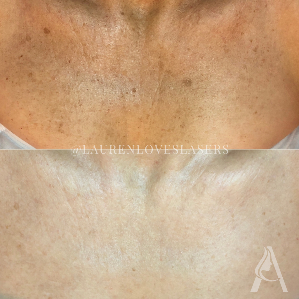 BBL HEROic Broadband Light Treatment Chest Before and After Philadelphia | Ari Blanc Medical Spa BBL HEROic chest before and after in Philadelphia showing improvement in sun damage, discoloration, and uneven tone on the décolletage.