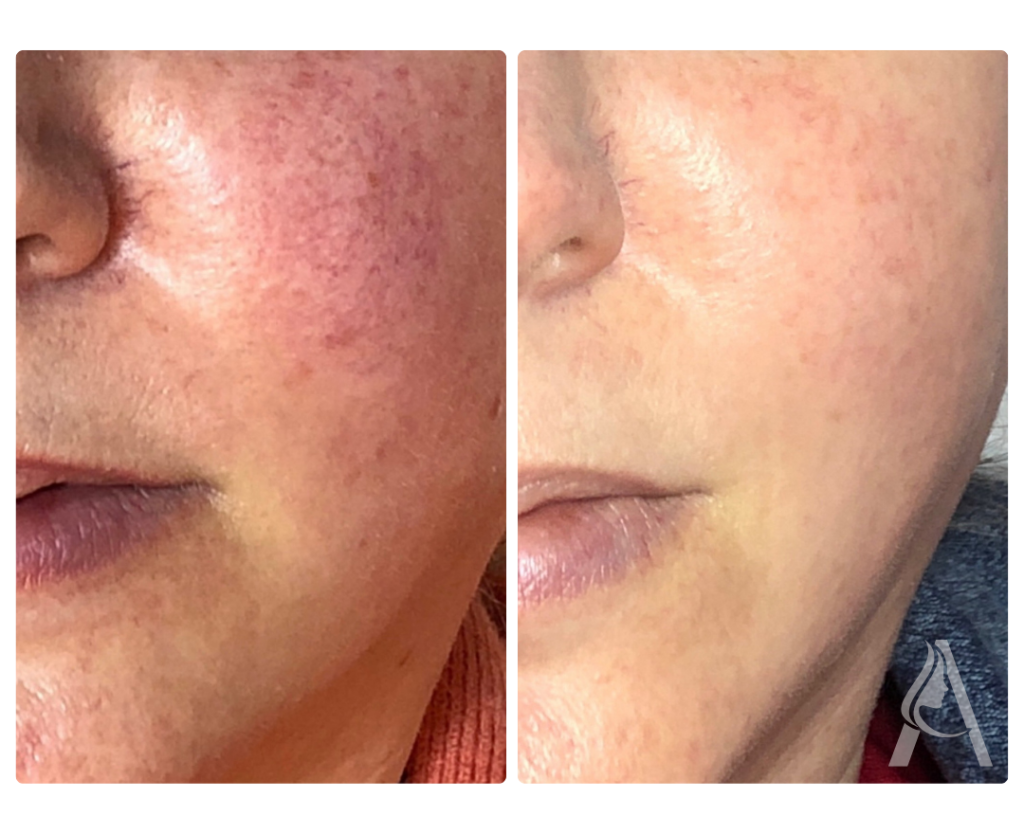 Before BBL HEROic Treatment Philadelphia | Ari Blanc Medical Spa Before BBL HEROic treatment close-up in Philadelphia showing sun damage, freckles, pigmentation, and uneven skin tone.