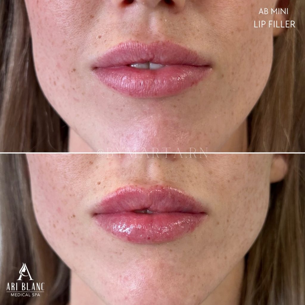 AB Mini Lip Filler in Philadelphia | Subtle Lip Enhancement Before and after AB Mini lip filler in Philadelphia showing subtle volume and improved lip definition.