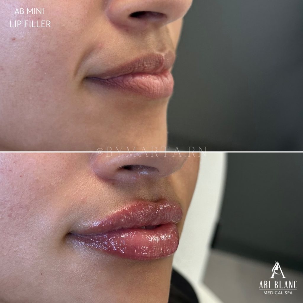 AB Mini Lip Filler in Philadelphia | Subtle Profile Enhancement Before and after AB Mini lip filler in Philadelphia showing subtle volume and improved lip contour from the side.