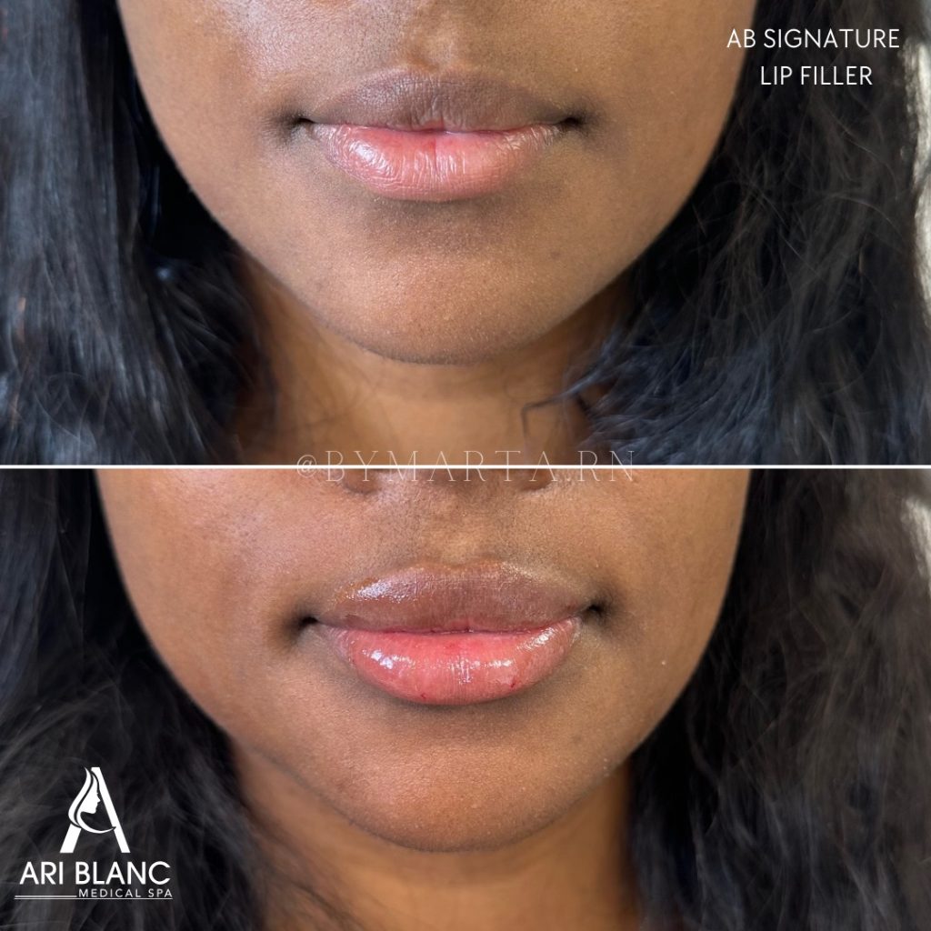 AB Signature Lip Filler Philadelphia | Natural Volume & Balance Before and after AB Signature lip filler in Philadelphia showing enhanced volume and smooth lip definition.