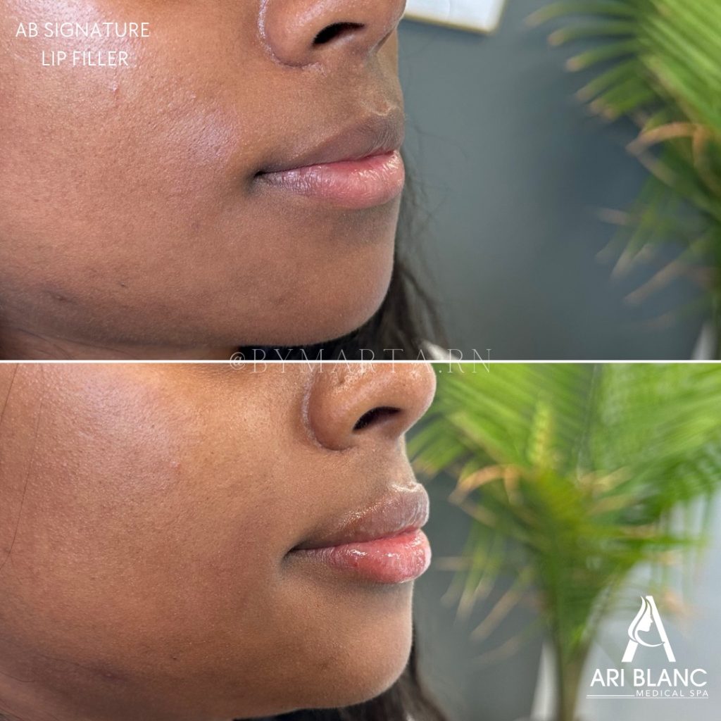 AB Signature Lip Filler Philadelphia | Profile Enhancement Before and after lip filler in Philadelphia showing improved projection and smooth lip contour from the side.