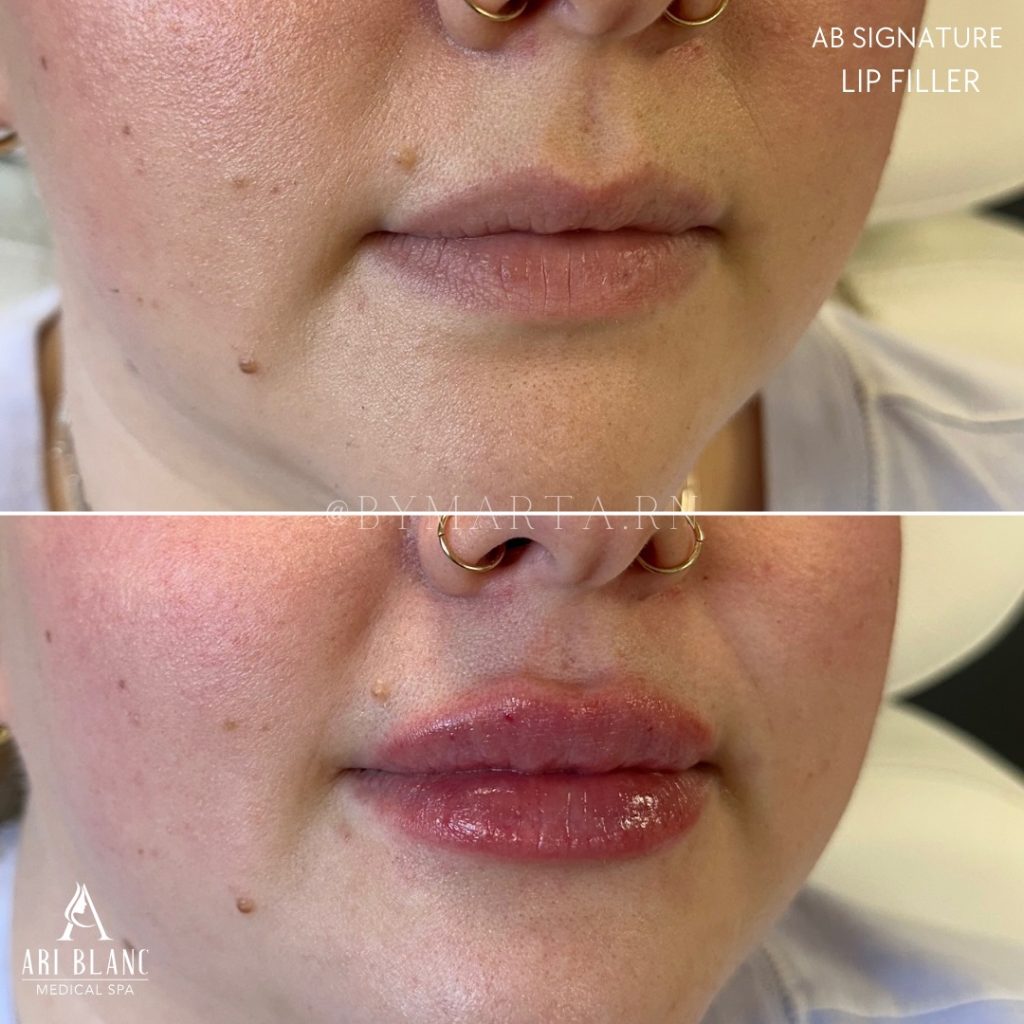 AB Signature Lip Filler Philadelphia | Balanced Volume Before and after AB Signature lip filler in Philadelphia showing enhanced lip volume and symmetry.