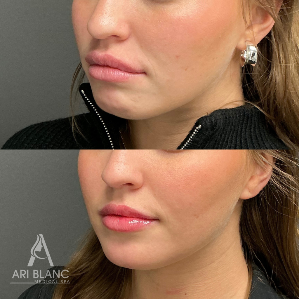 Botox for DAO and Chin | Lower Face Neuromodulator Before and After - Philly Before and after lower face neuromodulator treatment showing improvement in downturned mouth corners, chin dimpling, and lower face tension after Botox, Jeuveau, or Dysport.