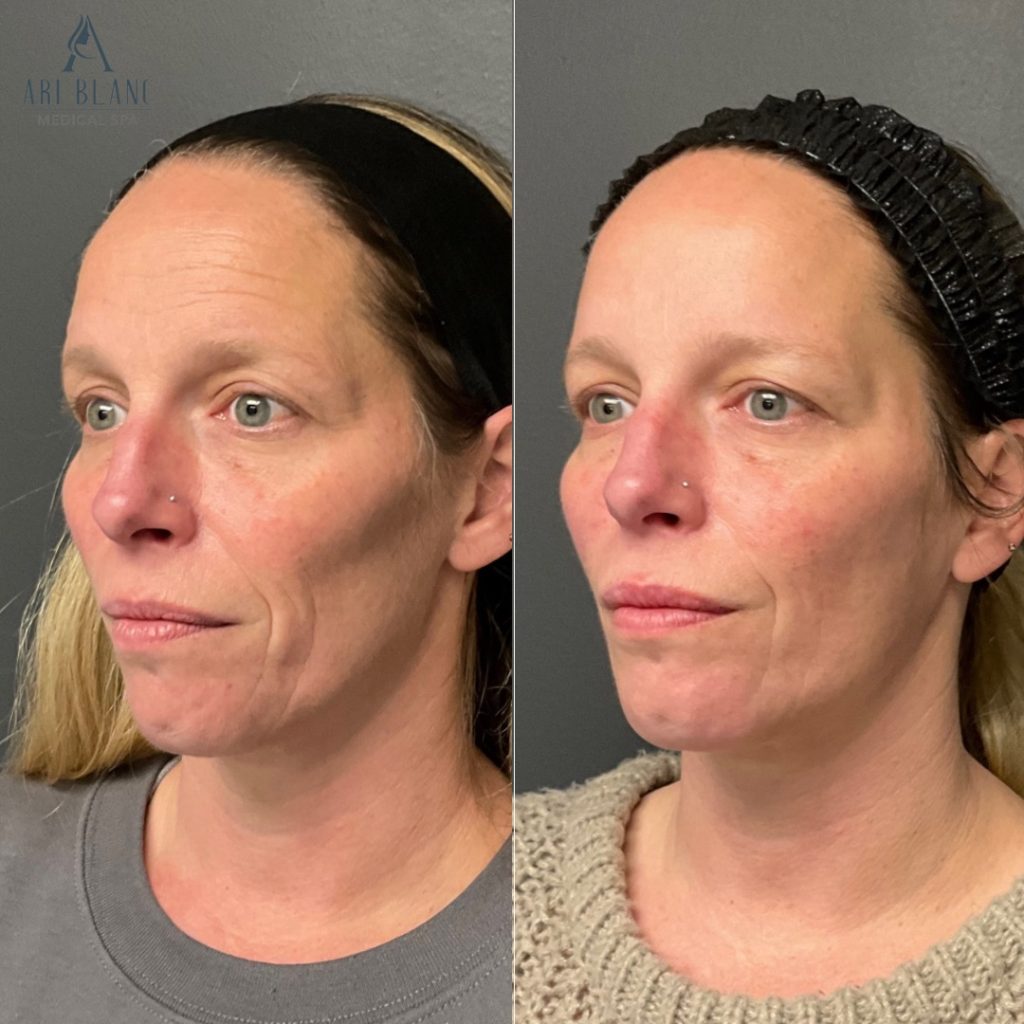 Facial Balancing with Dermal Filler in Philadelphia | Ari Blanc Medical Spa Before and after facial balancing with dermal filler in Philadelphia showing improved chin, jawline, and midface contour.
