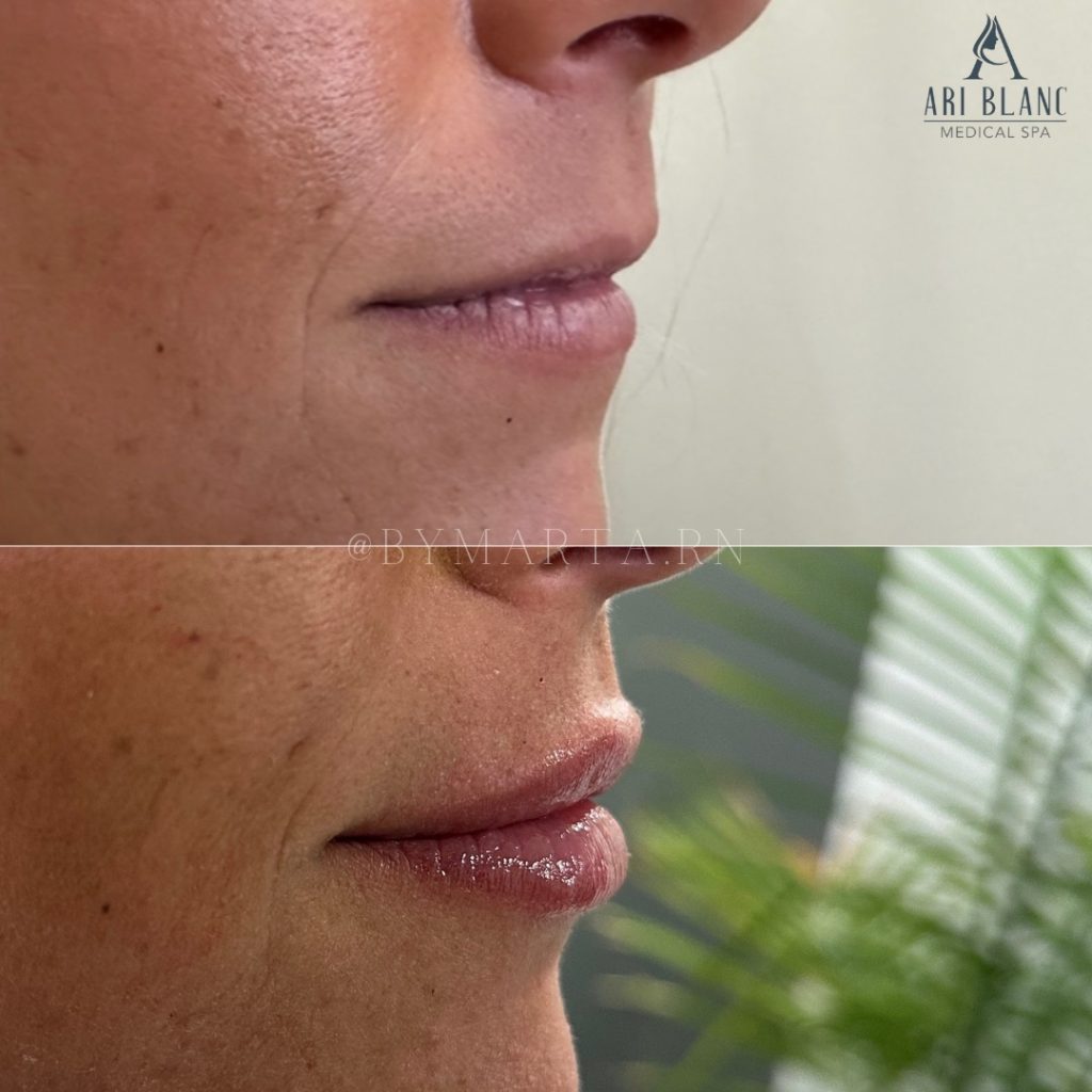 Hyaluronic Acid Lip Filler Philadelphia | Natural Projection Before and after lip filler in Philadelphia showing enhanced projection and smoother lip contour.
