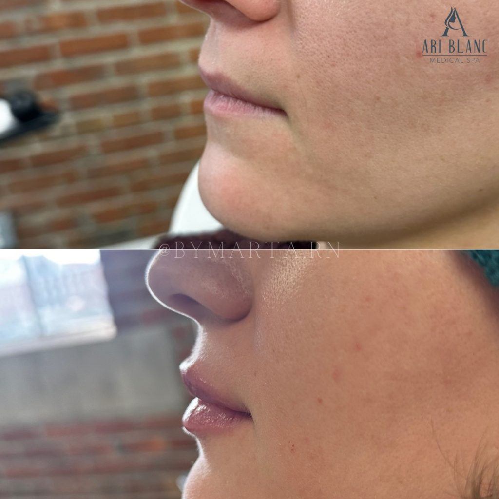 Lip Filler Profile Enhancement in Philadelphia | Natural Lip Projection Before and after lip filler in Philadelphia showing improved lip projection and natural definition.