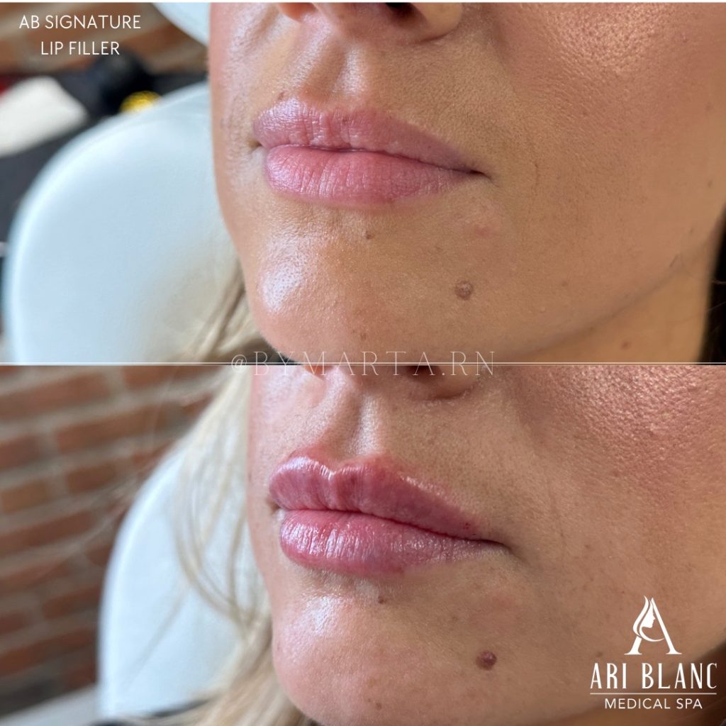 Lip Filler Profile Results in Philadelphia | Natural Projection Before and after lip filler in Philadelphia showing improved lip projection and contour from a side angle.