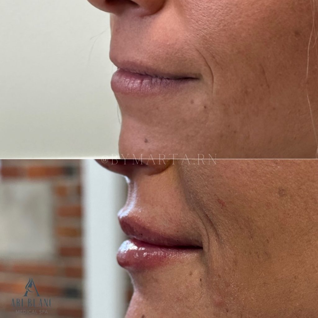 Lip Filler for Volume Restoration in Philadelphia Before and after lip filler in Philadelphia showing restored lip volume and smoother contour.