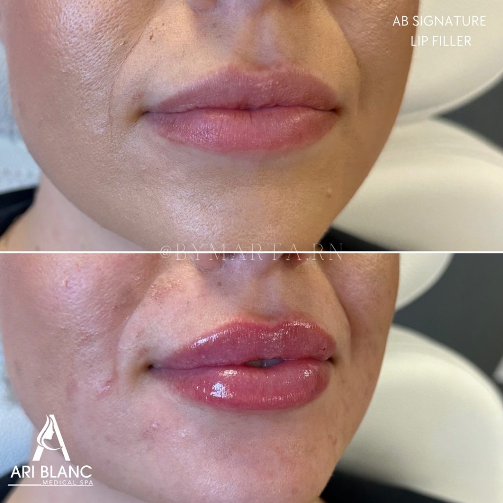 Lip Injections in Philadelphia | Soft Volume Enhancement Before and after lip injections in Philadelphia showing enhanced volume and improved lip symmetry.