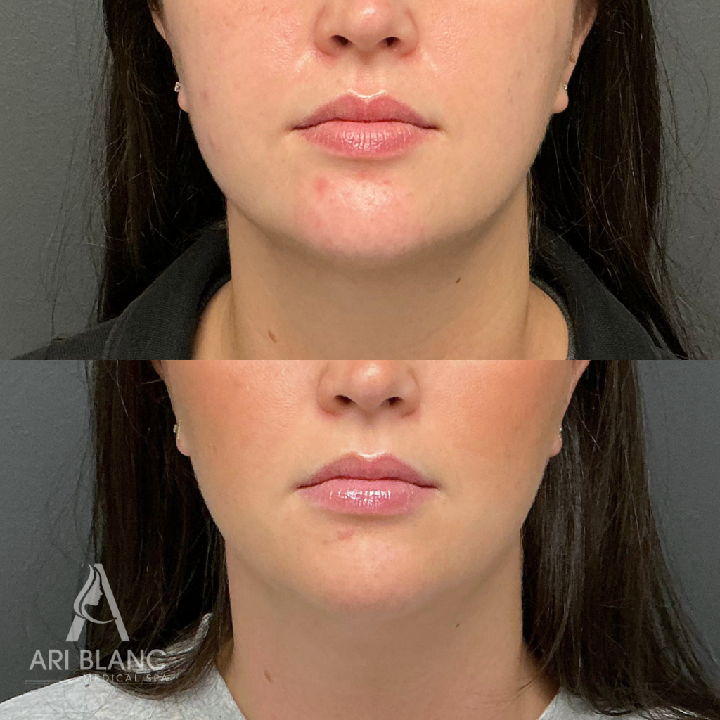 Masseter Botox | Jawline Slimming Before and After - Old City, Philadelphia Before and after masseter neuromodulator treatment showing facial slimming and jawline softening after Botox, Jeuveau, or Dysport for enlarged masseter muscles.