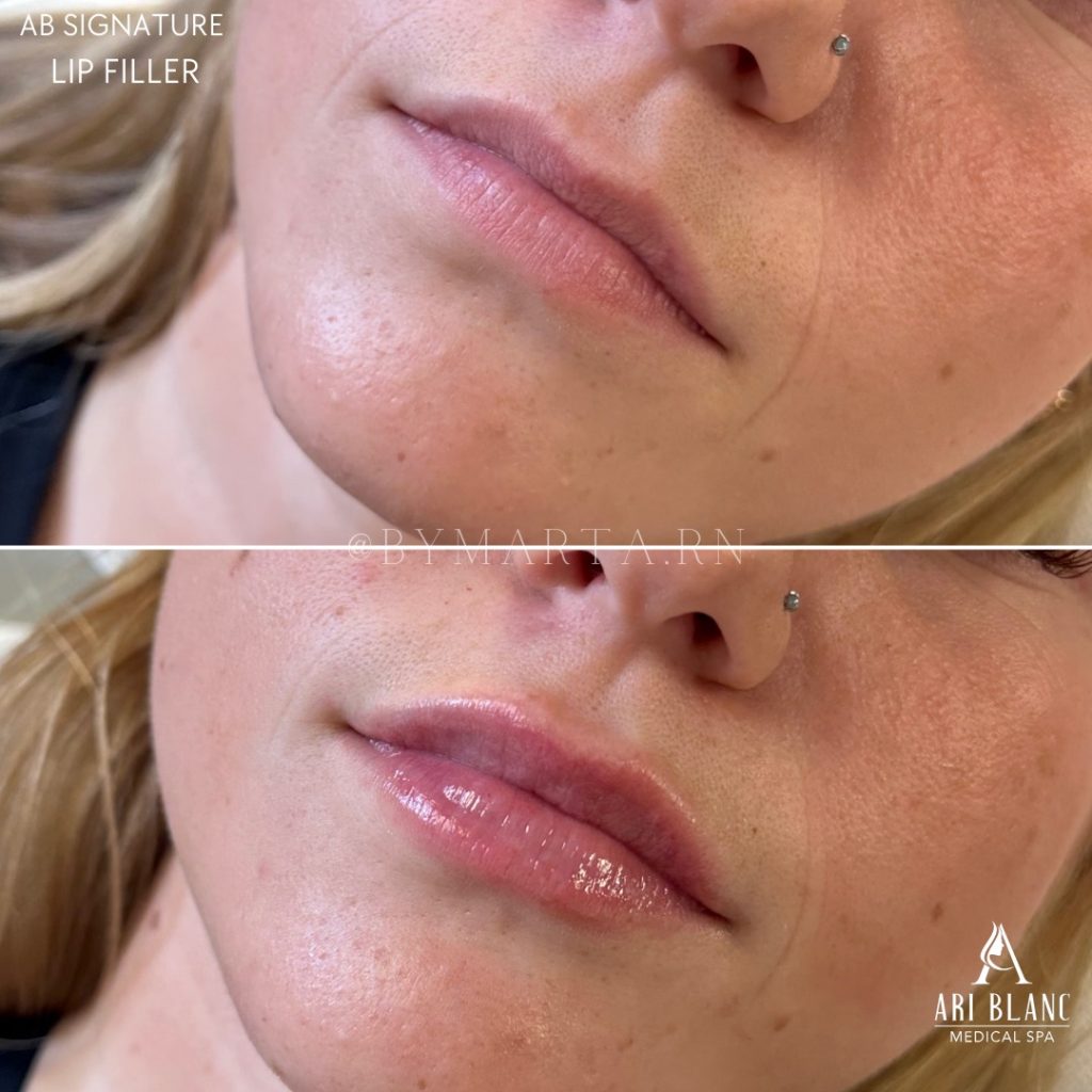 Natural Lip Filler Results in Philadelphia | Refined Contour Before and after lip filler in Philadelphia showing improved lip contour and soft volume.