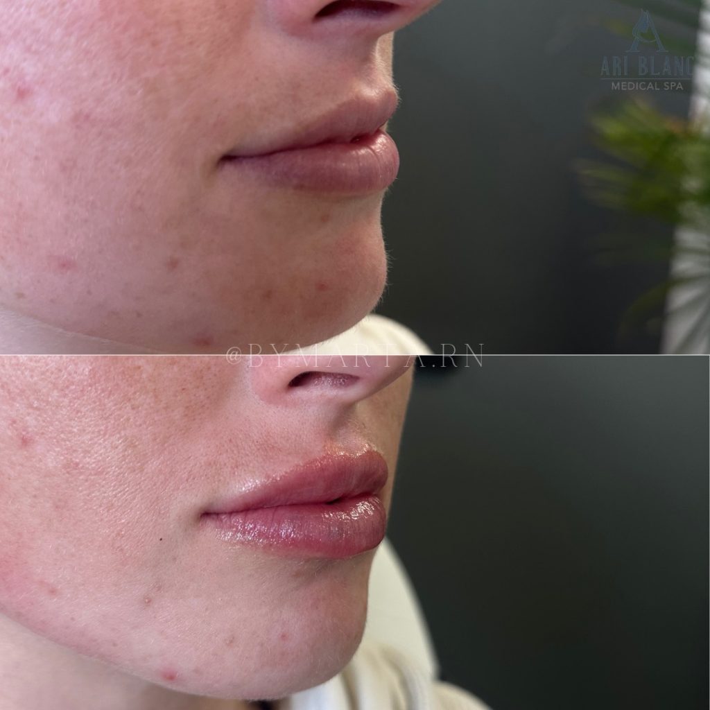 Natural Lip Filler Philadelphia | Soft Volume & Definition Before and after natural lip filler in Philadelphia showing enhanced lip volume and smooth contour.