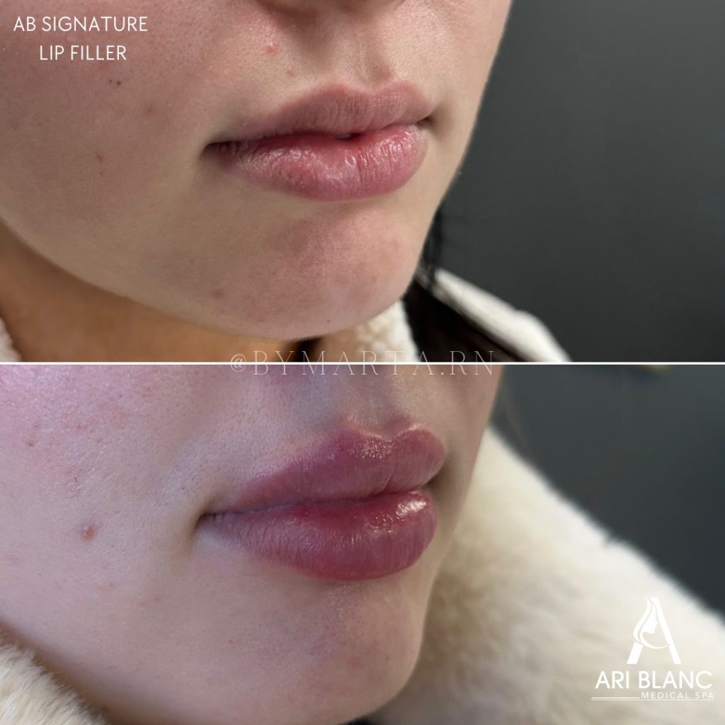 Natural Lip Injections in Philadelphia | Soft Volume Enhancement Before and after natural lip injections in Philadelphia showing soft volume and defined lip borders.