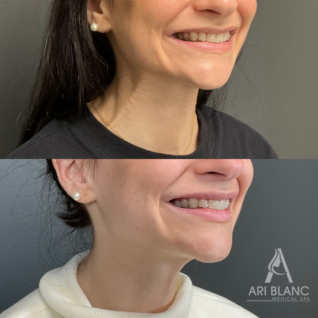 Botox for Neck Bands | Platysmal Band Treatment Before and After Before and after of neuromodulator treatment for visible neck bands, showing improvement in platysmal bands after Botox, Jeuveau, or Dysport to soften vertical neck banding and create a smoother-looking neck.