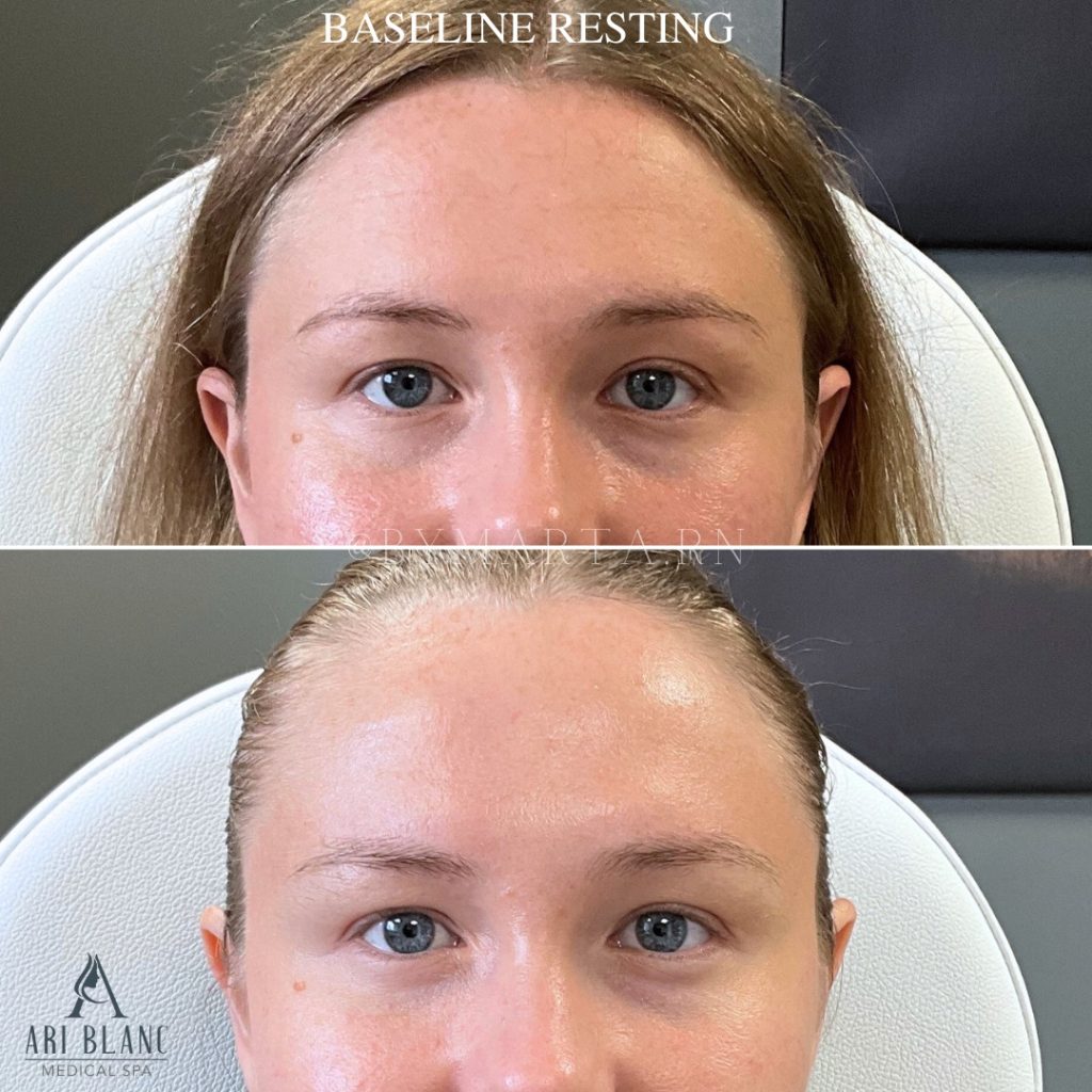 Neuromodulator Before and After | Baseline Resting Baseline resting before and after neuromodulator treatment showing smoother upper face appearance with Botox, Jeuveau, or Dysport for forehead lines, frown lines, and brow balance.