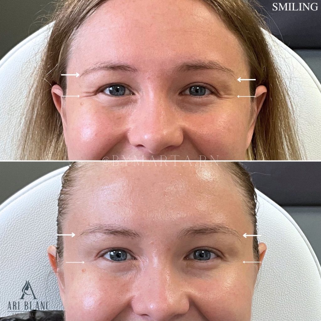 Botox for Crow’s Feet | Smile Lines Before and After Before and after neuromodulator treatment for crow’s feet showing softened smile lines at the outer corners of the eyes after Botox, Jeuveau, or Dysport.
