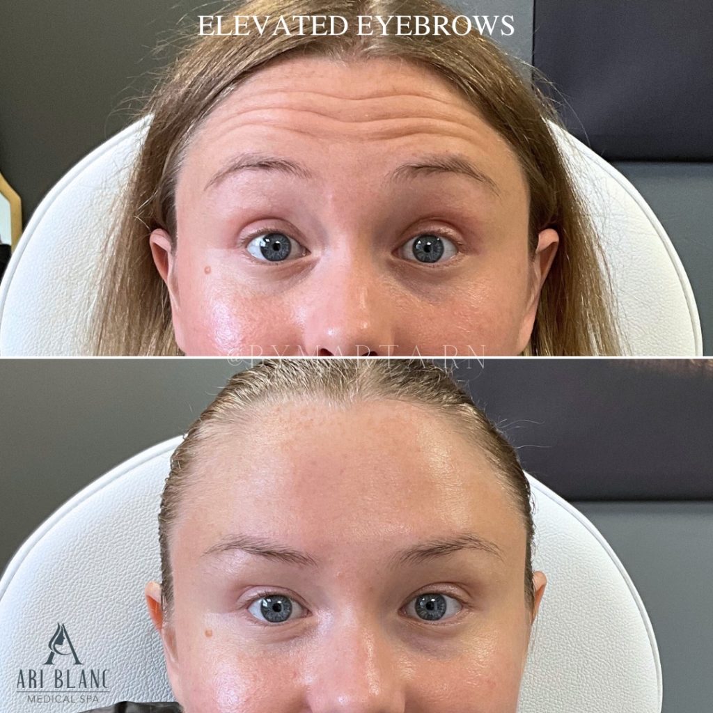 Botox Brow Lift | Elevated Eyebrows Before and After - Botox Near Me Before and after neuromodulator treatment showing elevated eyebrows and a subtle Botox brow lift with smoother upper face balance after Botox, Jeuveau, or Dysport.