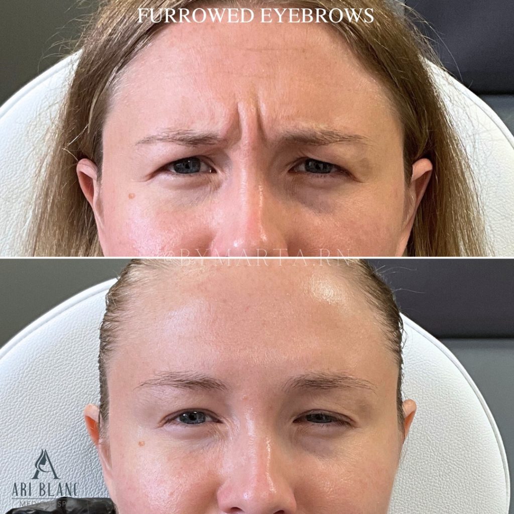Botox for Frown Lines | 11 Lines Before and After - Botox in Philly Before and after neuromodulator treatment for frown lines and glabellar lines showing softened 11 lines between the brows after Botox, Jeuveau, or Dysport.