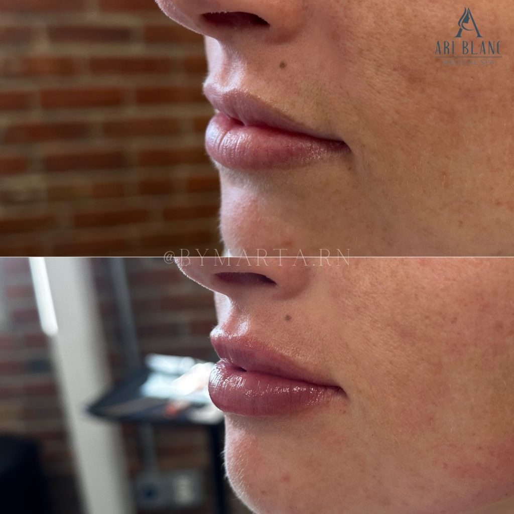 Subtle Lip Enhancement in Philadelphia | Natural Lip Filler Before and after subtle lip filler in Philadelphia showing improved lip definition and hydration.