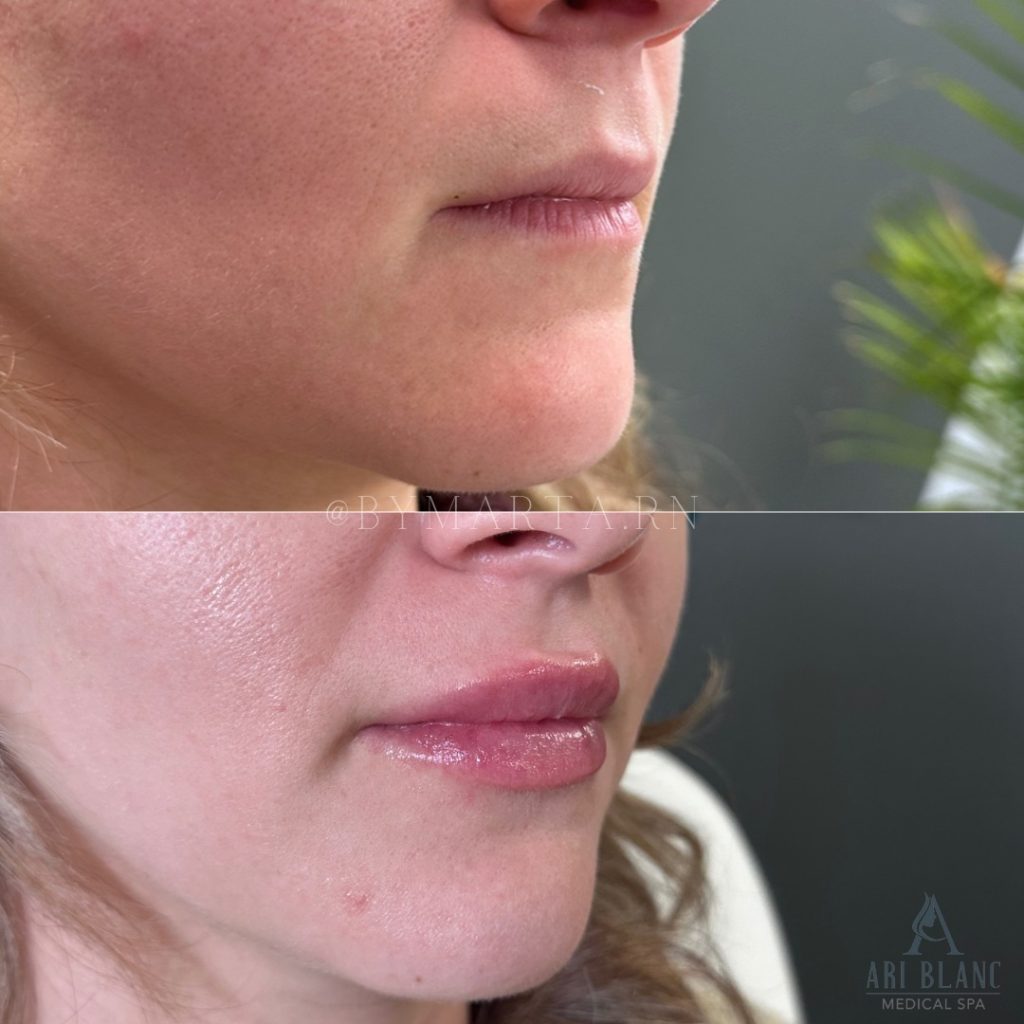 Subtle Hyaluronic Acid Lip Filler in Philadelphia | Natural Volume Enhancement Before and after hyaluronic acid lip filler in Philadelphia showing enhanced volume and smooth contour.