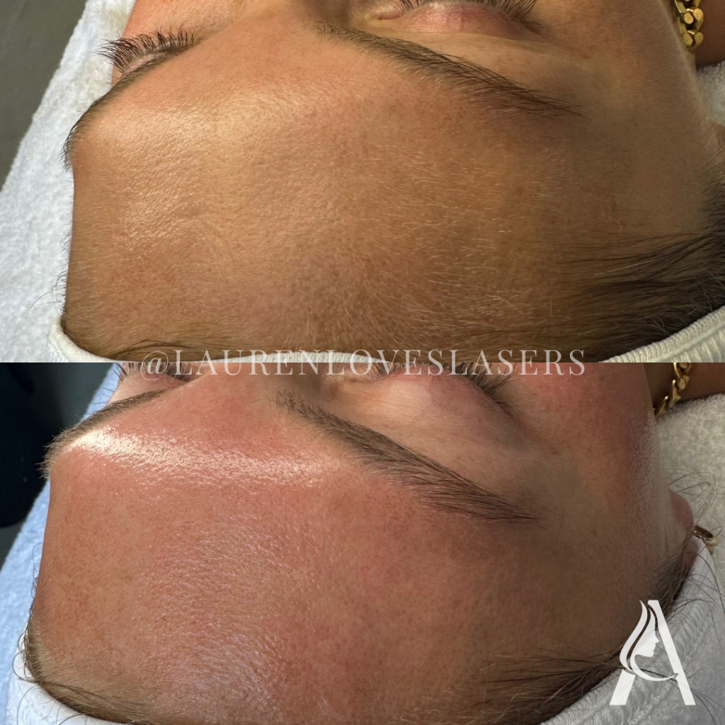 Hydrafacial in Philadelphia Before and After Clearer-Looking Skin | Ari Blanc Medical Spa Before and after Hydrafacial in Philadelphia showing clearer-looking skin and a smoother, brighter finish