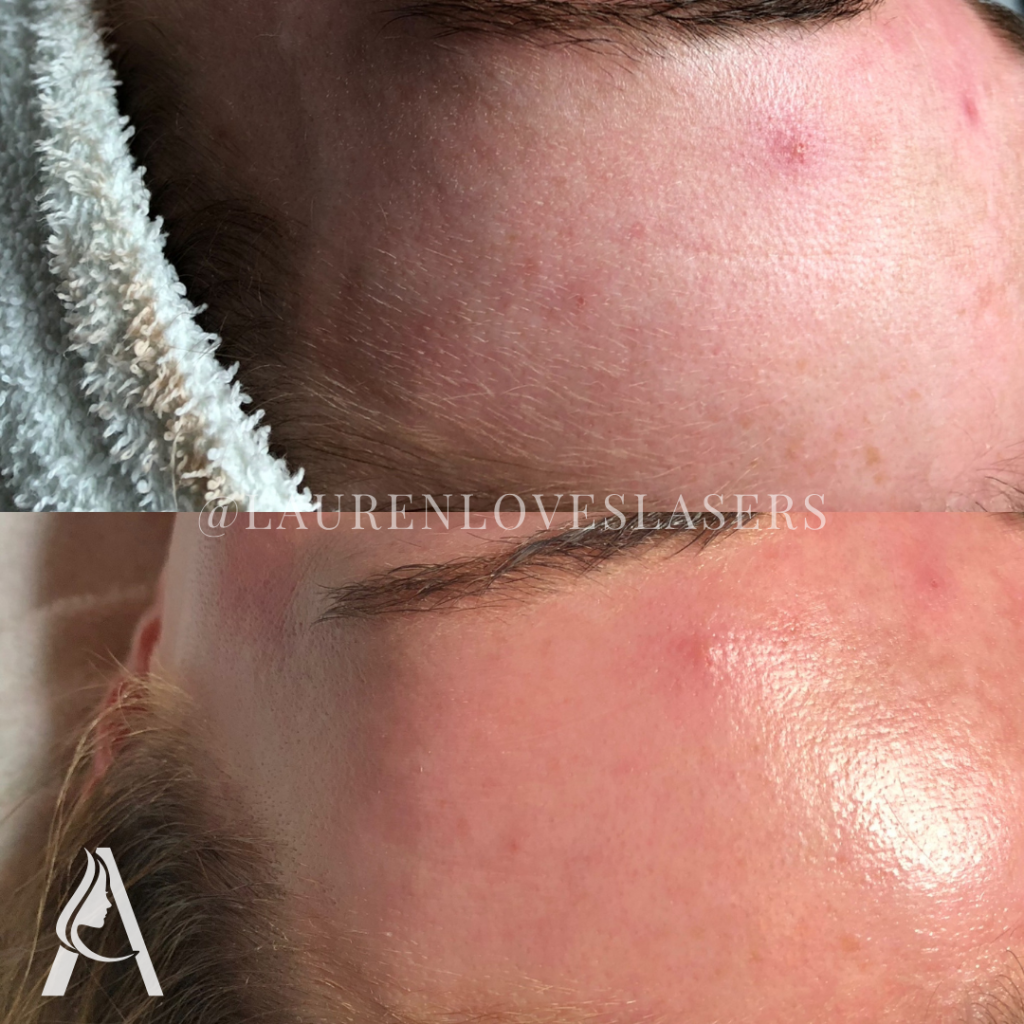 Hydrafacial in Philadelphia Before and After Forehead Smoothness | Ari Blanc Medical Spa Before and after Hydrafacial in Philadelphia showing a smoother-looking forehead and more radiant skin