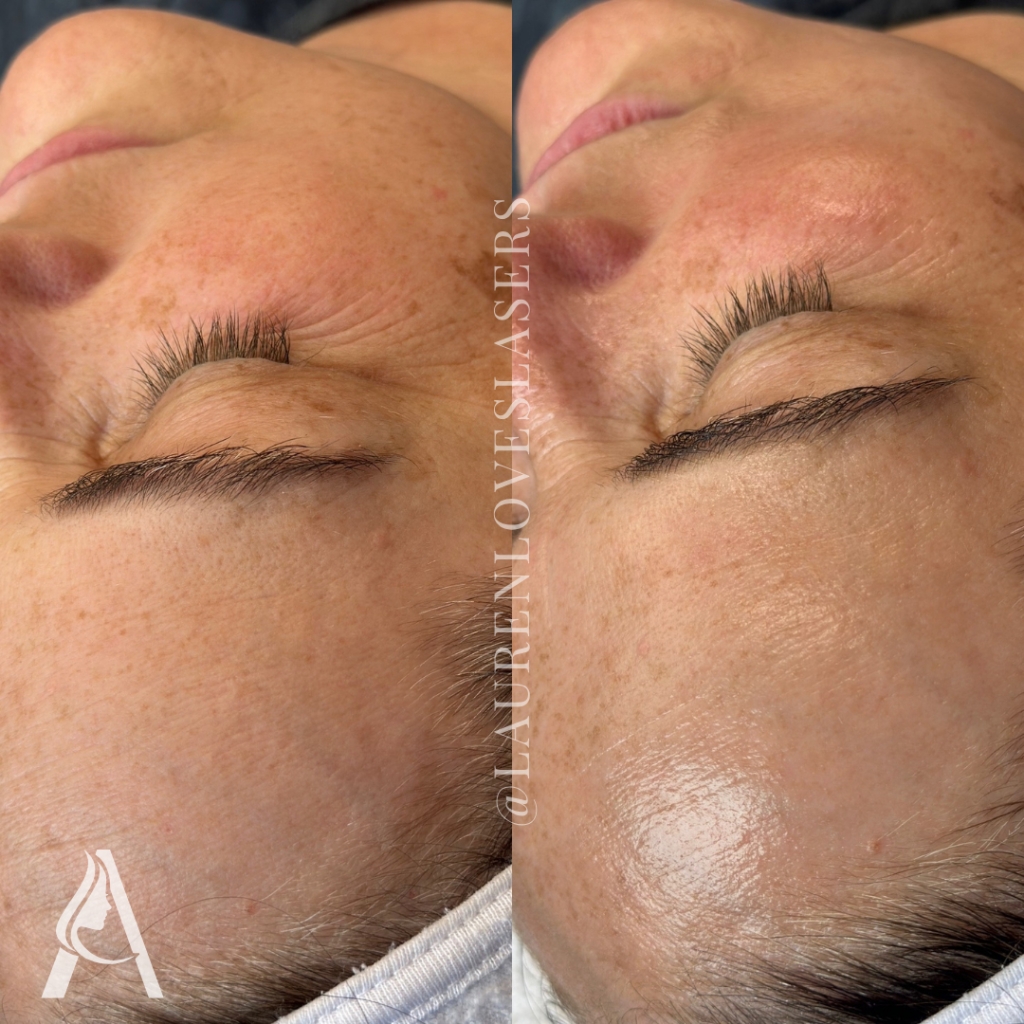 Hydrafacial in Philadelphia Before and After Healthy Glow | Ari Blanc Medical Spa Before and after Hydrafacial in Philadelphia showing smoother-looking skin and a healthy glow on freckled skin