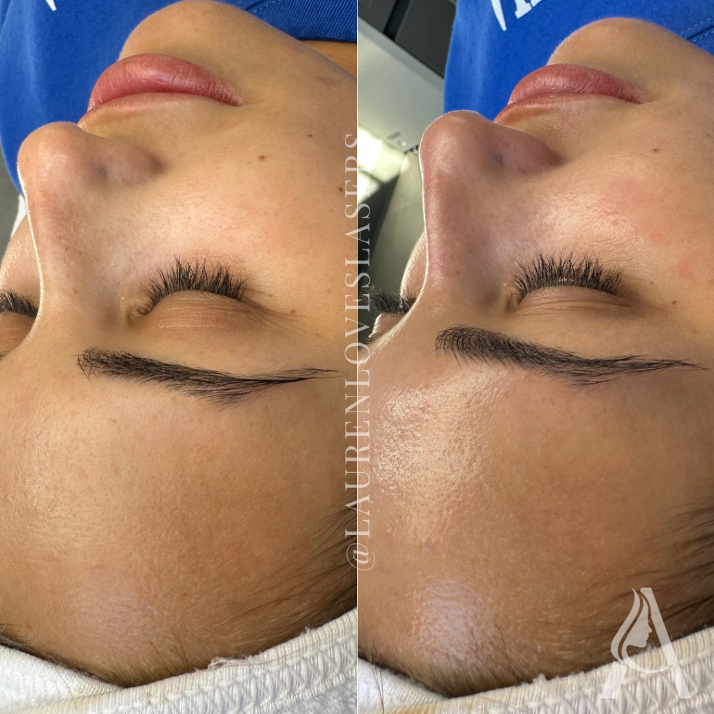 Hydrafacial in Philadelphia Before and After Glow | Ari Blanc Medical Spa Before and after Hydrafacial in Philadelphia showing smoother, more radiant-looking skin and improved glow