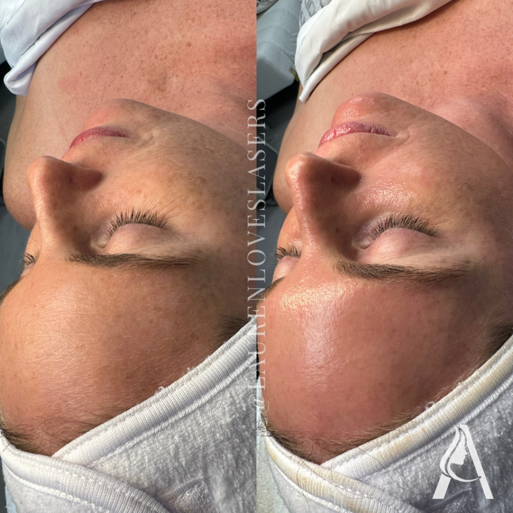 Hydrafacial in Philadelphia Before and After Hydration | Ari Blanc Medical Spa Before and after Hydrafacial in Philadelphia showing more hydrated-looking skin and a dewier finish