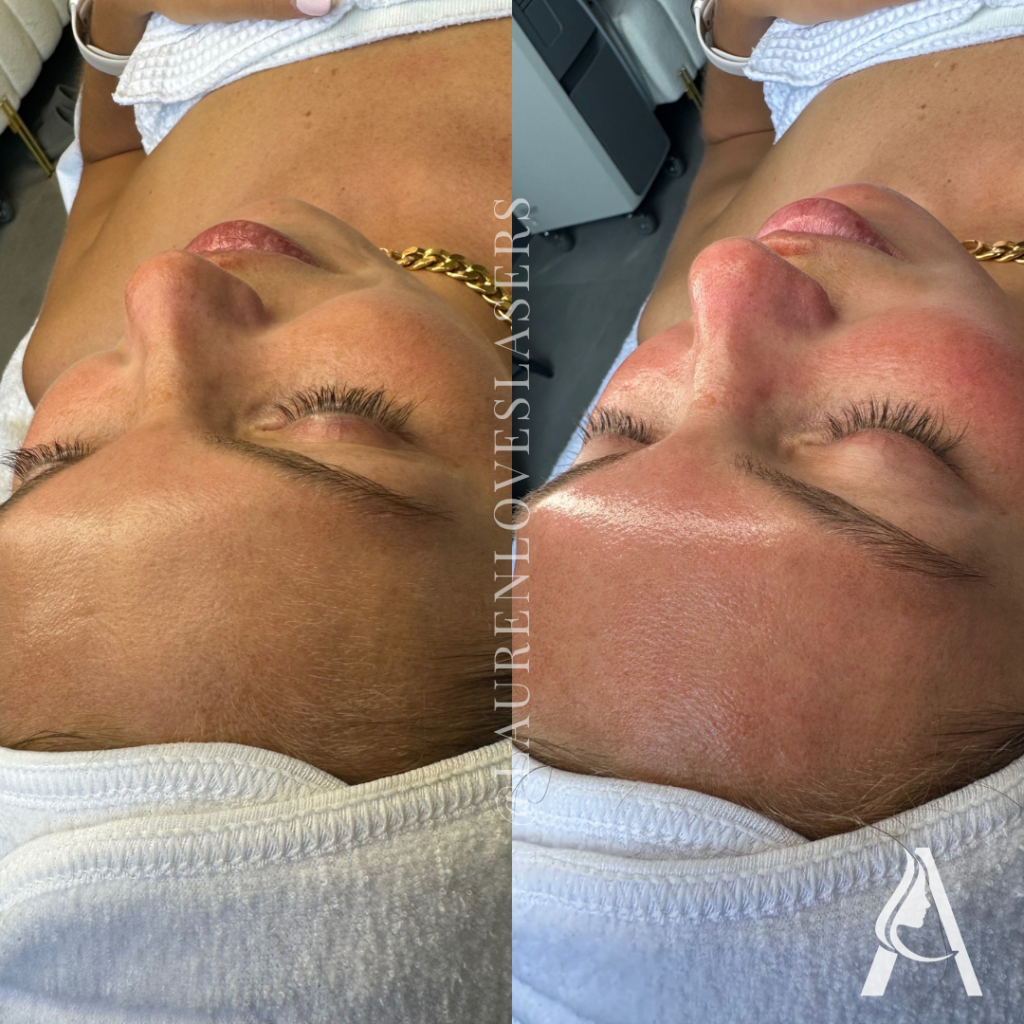 Hydrafacial in Philadelphia Before and After Radiance | Ari Blanc Medical Spa Before and after Hydrafacial in Philadelphia showing brighter-looking skin and improved surface smoothness