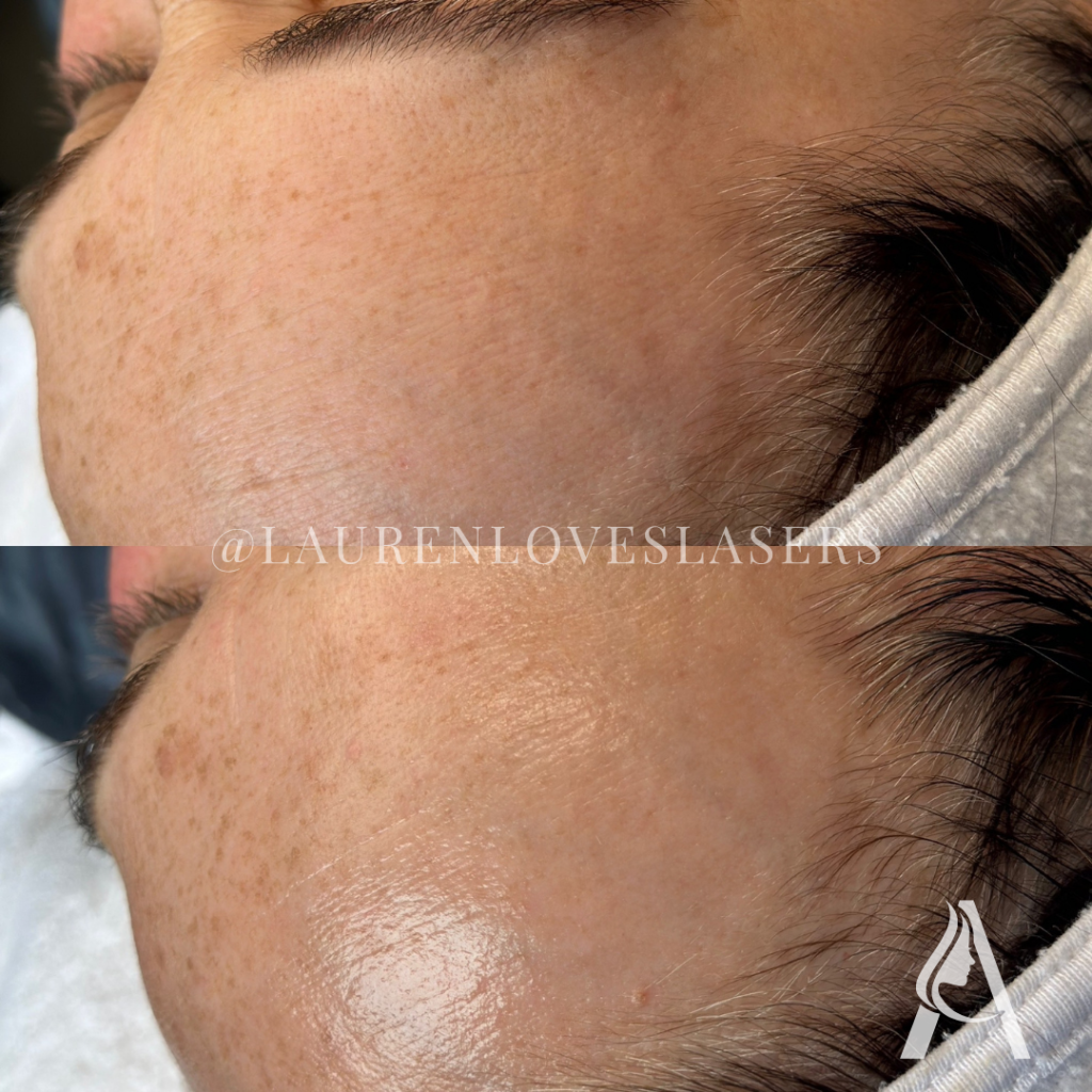 Hydrafacial in Philadelphia Before and After Skin Radiance | Ari Blanc Medical Spa Before and after Hydrafacial in Philadelphia showing more radiant-looking skin and a smoother complexion