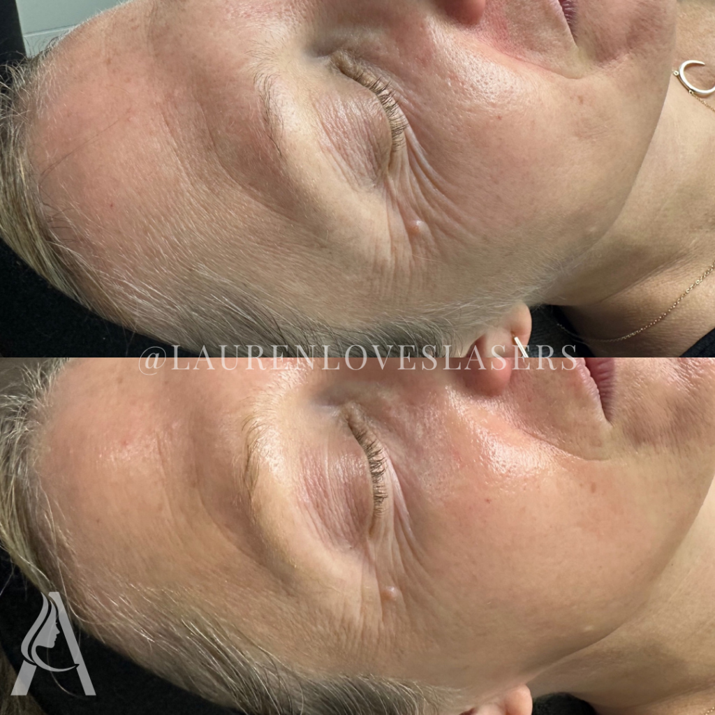 Hydrafacial in Philadelphia Before and After Skin Refresh | Ari Blanc Medical Spa Before and after Hydrafacial in Philadelphia showing smoother-looking skin and a more hydrated complexion
